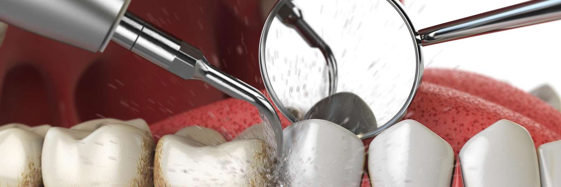 Dental cleaning of teeth stains in New Orleans