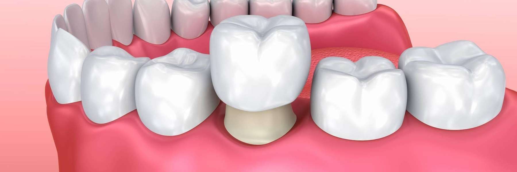 Customized dental crown in New Orleans
