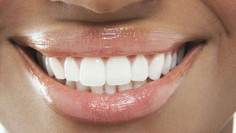 Woman's white teeth with disease free gums in New Orleans