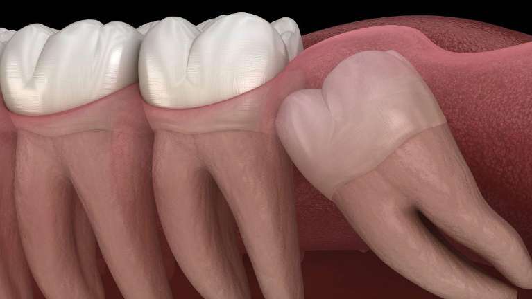 Slanted wisdom tooth in New Orleans