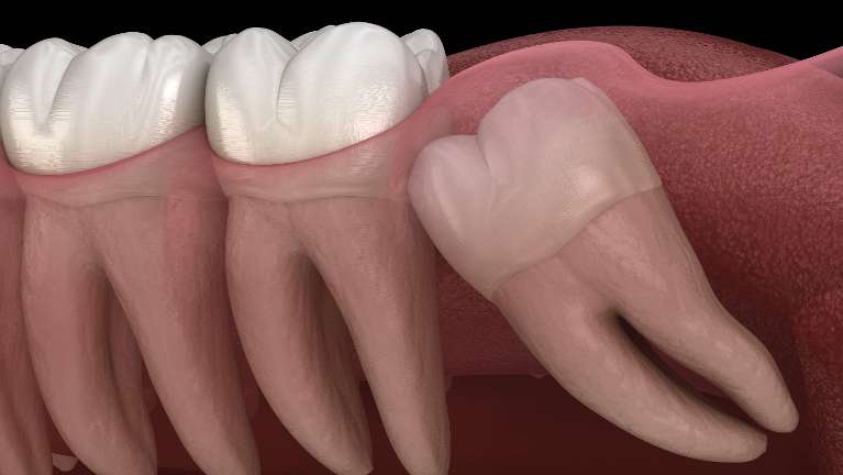 Close-up photo showing misaligned teeth and irregular tooth growth