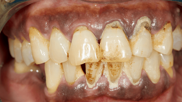 plaque buildup and signs of gum infection in New Orleans