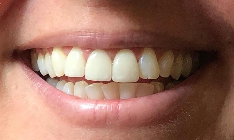 dental crowns | new orleans 