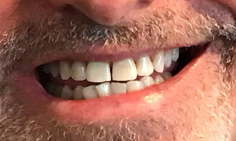 bright teeth after teeth whitening | dentist downtown la