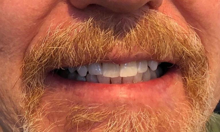 white smile after teeth whitening | cosmetic dentist new orleans