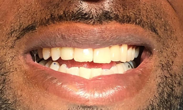 bright smile after veneers | new orleans dentist