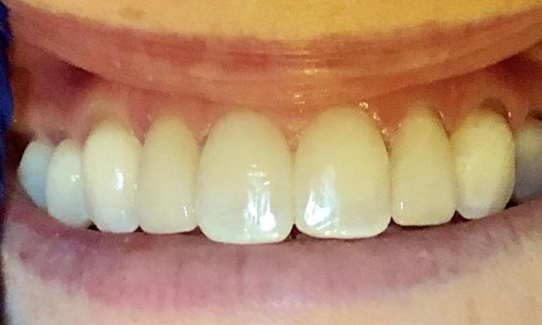 veneers | new orleans 