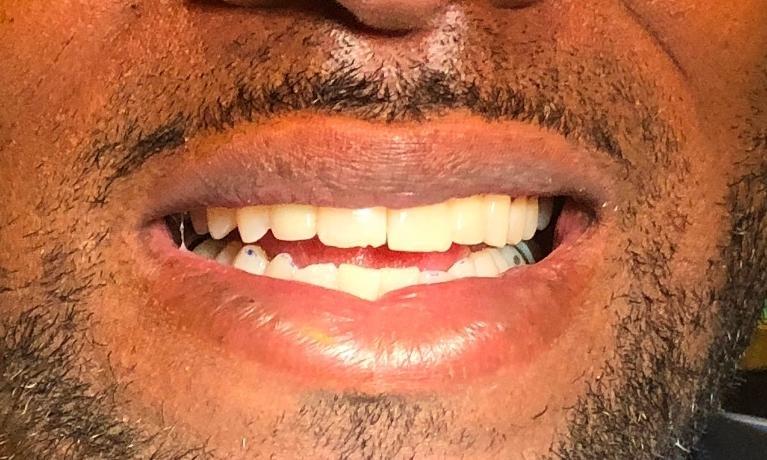 veneers | new orleans 