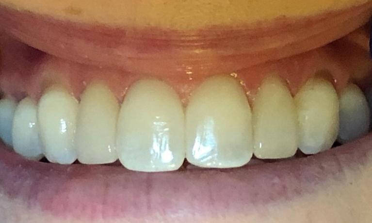 veneers | new orleans 