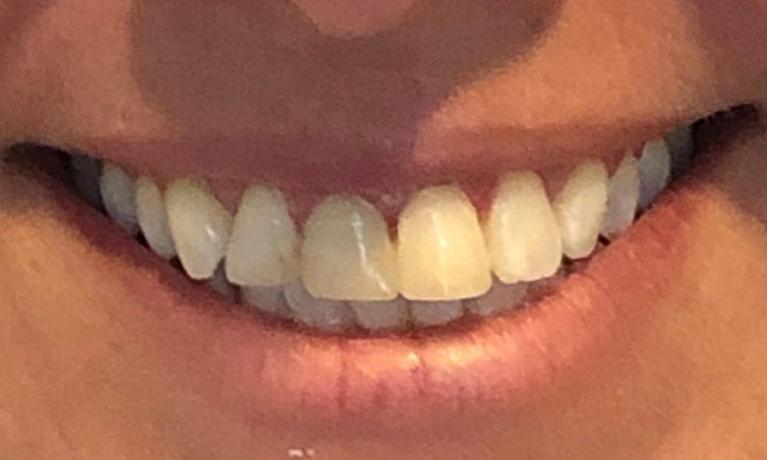 dental crowns | new orleans 