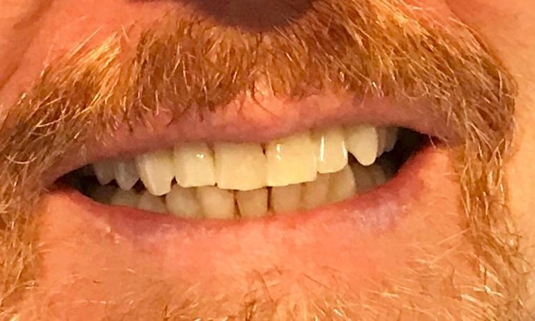 dingy teeth before teeth whitening | new orleans dentist
