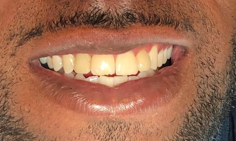stained teeth before veneers | cosmetic dentist new orleans