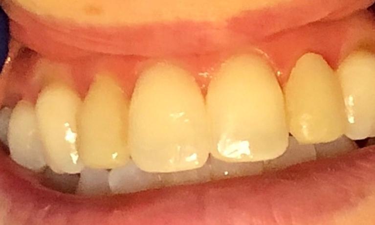 veneers | new orleans 