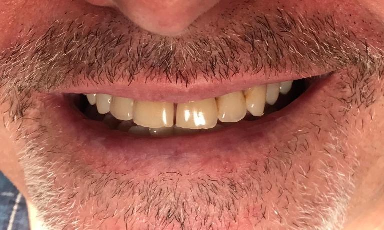 dingy teeth before teeth whitening | dentist new orleans